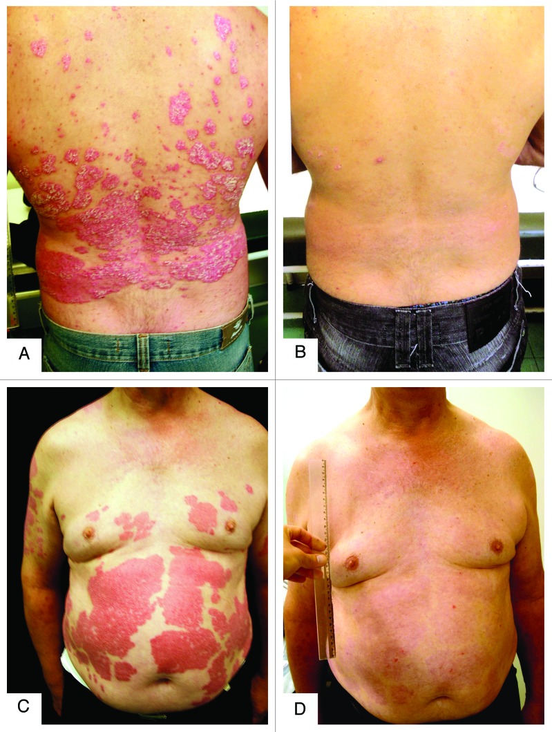 brazil psoriasis and vitamin d3 connection 2008